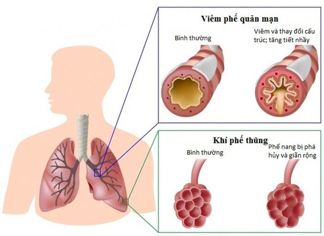 Viêm phổi kẽ là gì có nguy hiểm không?